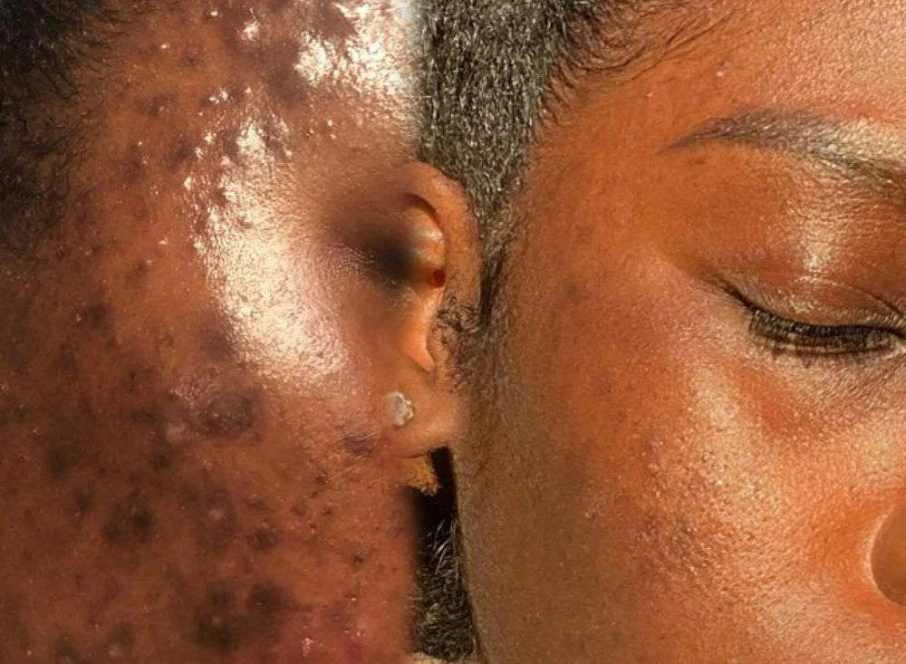 Comparatif avant après traitement anti-imperfections