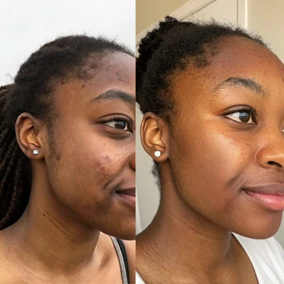 Comparatif avant après traitement anti-imperfections